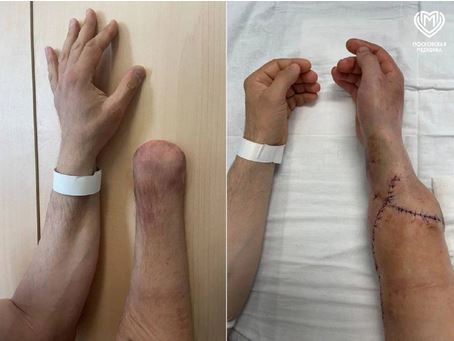 Trasplantes de manos