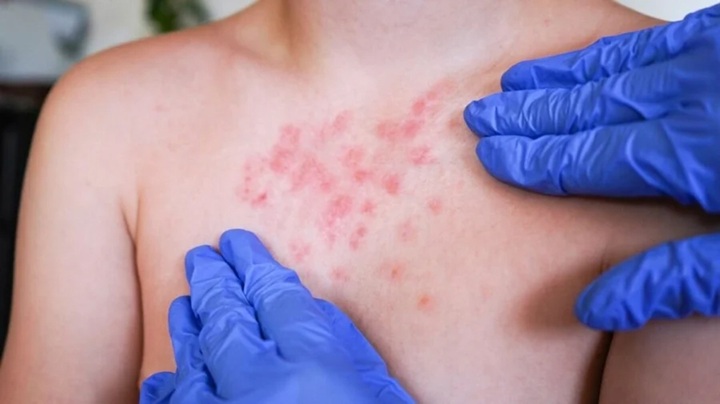 Back with measles Back with measles